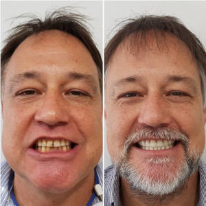 Comparison of a patient's teeth before and after dental surgery