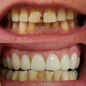 Comparison of a patient's teeth before and after dental surgery