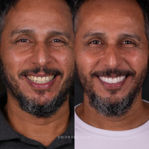 Comparison of a patient's teeth before and after dental surgery
