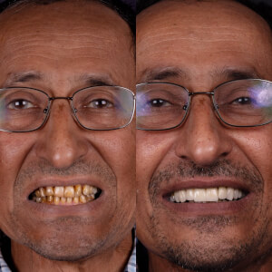 Comparison of a patient's teeth before and after dental surgery