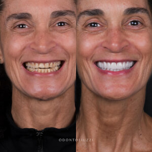Comparison of a patient's teeth before and after dental surgery