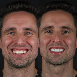 Comparison of a patient's teeth before and after dental surgery