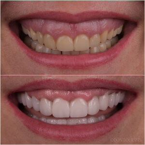 Comparison of a patient's teeth before and after dental surgery