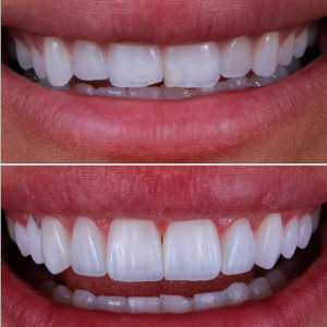 Comparison of a patient's teeth before and after dental surgery