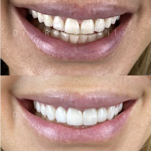 Comparison of a patient's teeth before and after dental surgery