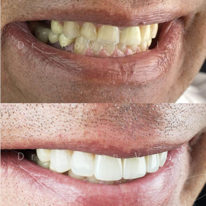 Comparison of a patient's teeth before and after dental surgery