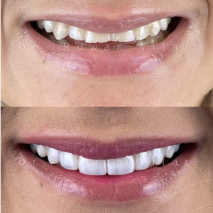 Comparison of a patient's teeth before and after dental surgery