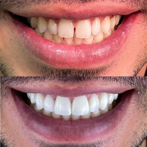 Comparison of a patient's teeth before and after dental surgery